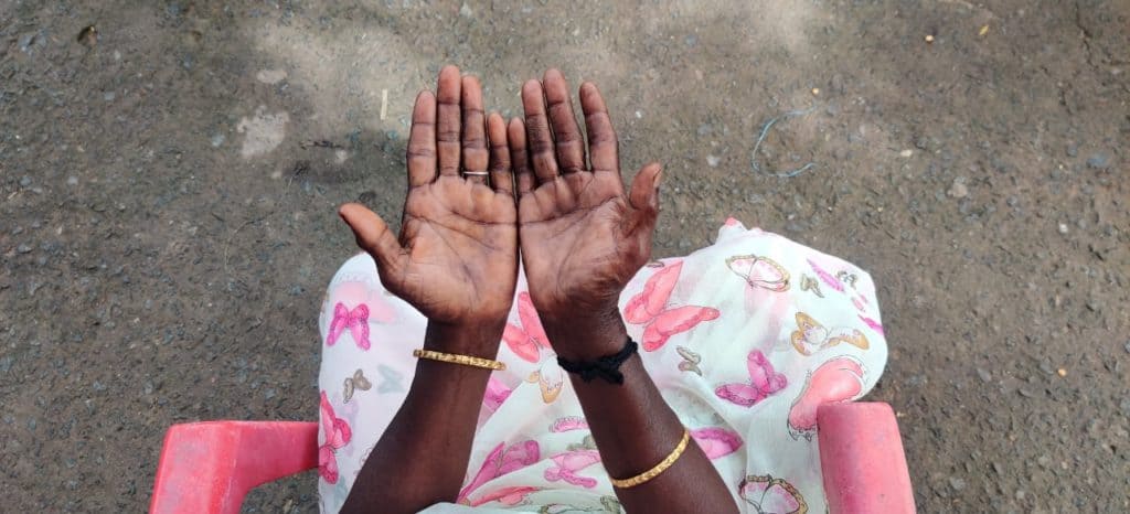 Worn out hands of a garment worker indicating hard labour