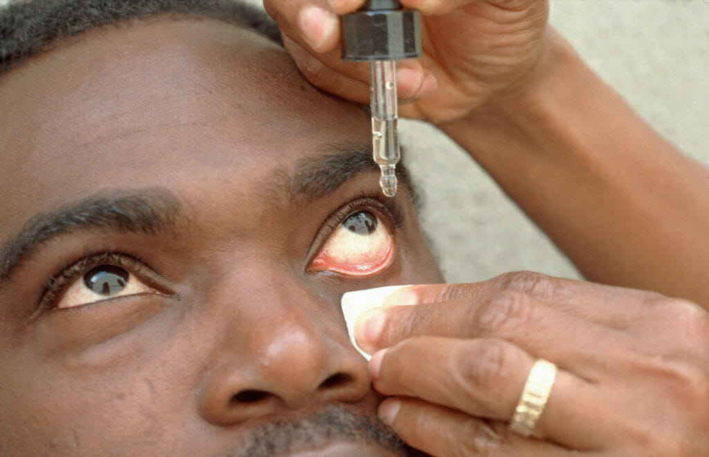 person applying eye drops